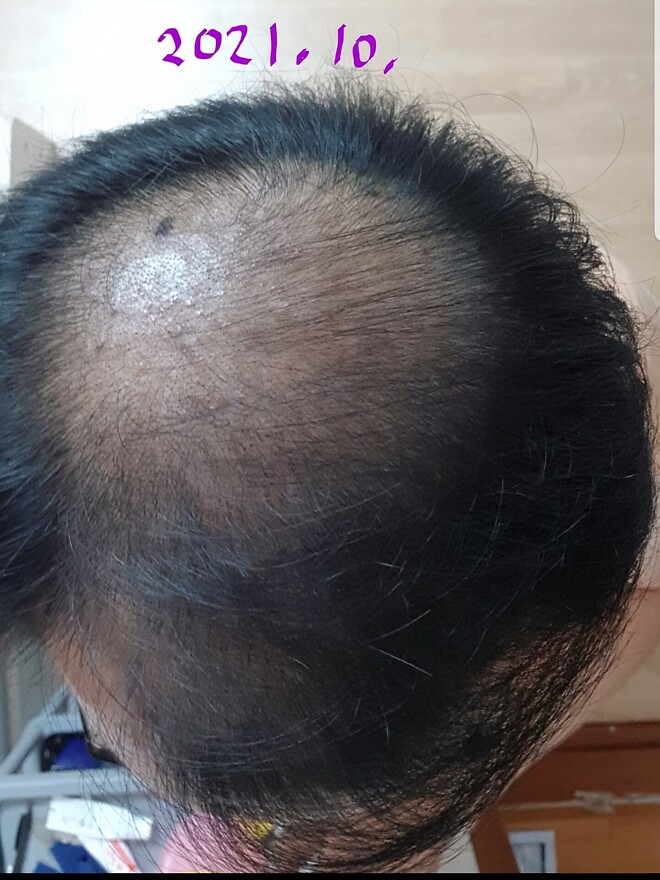 탈모에 또 희망을 불어넣는건가요.