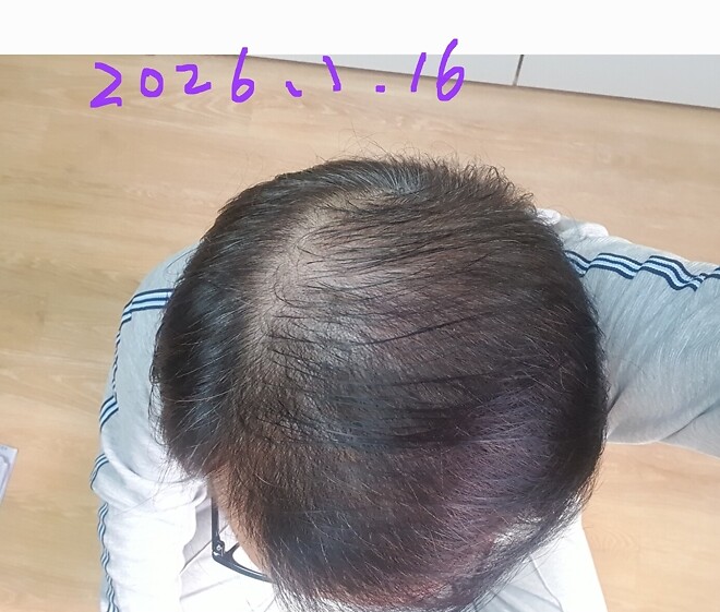 탈모에 또 희망을 불어넣는건가요.