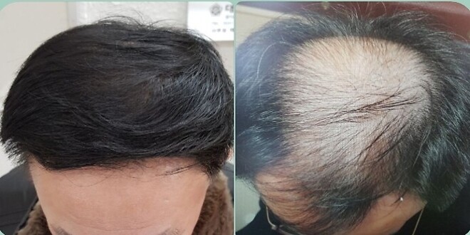 흰머리 염색 하세요?