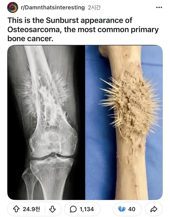 [약혐] 뼈에 종양이 자란 모습