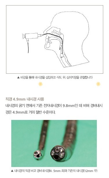 [위내시경] 코로 하는 경비위내시경