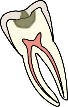 [DP지식인] 치과 치아