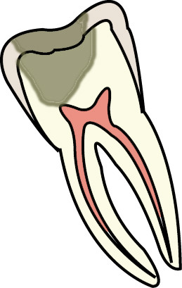 [DP지식인] 치과 치아