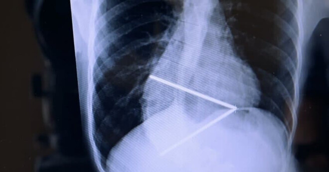 허리가 정말 안좋았던 역사적 인물