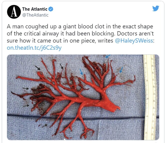 코로나 백신 근황