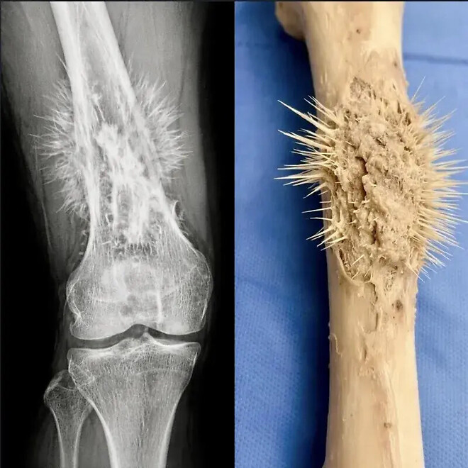 골육종 걸리면 엄청 아픈 이유.JGP